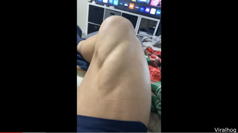 Insane Leg Cramp! (Video)